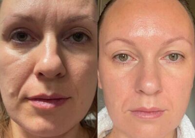 ošetření kosmetikou Miracletox, salon Provence, Monika Kubátová