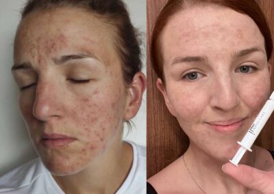 ošetření kosmetikou Miracletox, salon Provence, Monika Kubátová_3