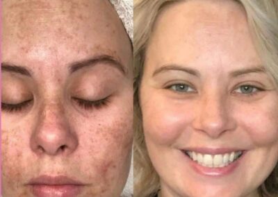ošetření kosmetikou Miracletox, salon Provence, Monika Kubátová_4